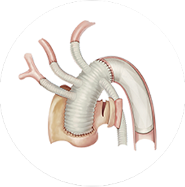 CRONUS? Stent Graft System in Surgical Operation