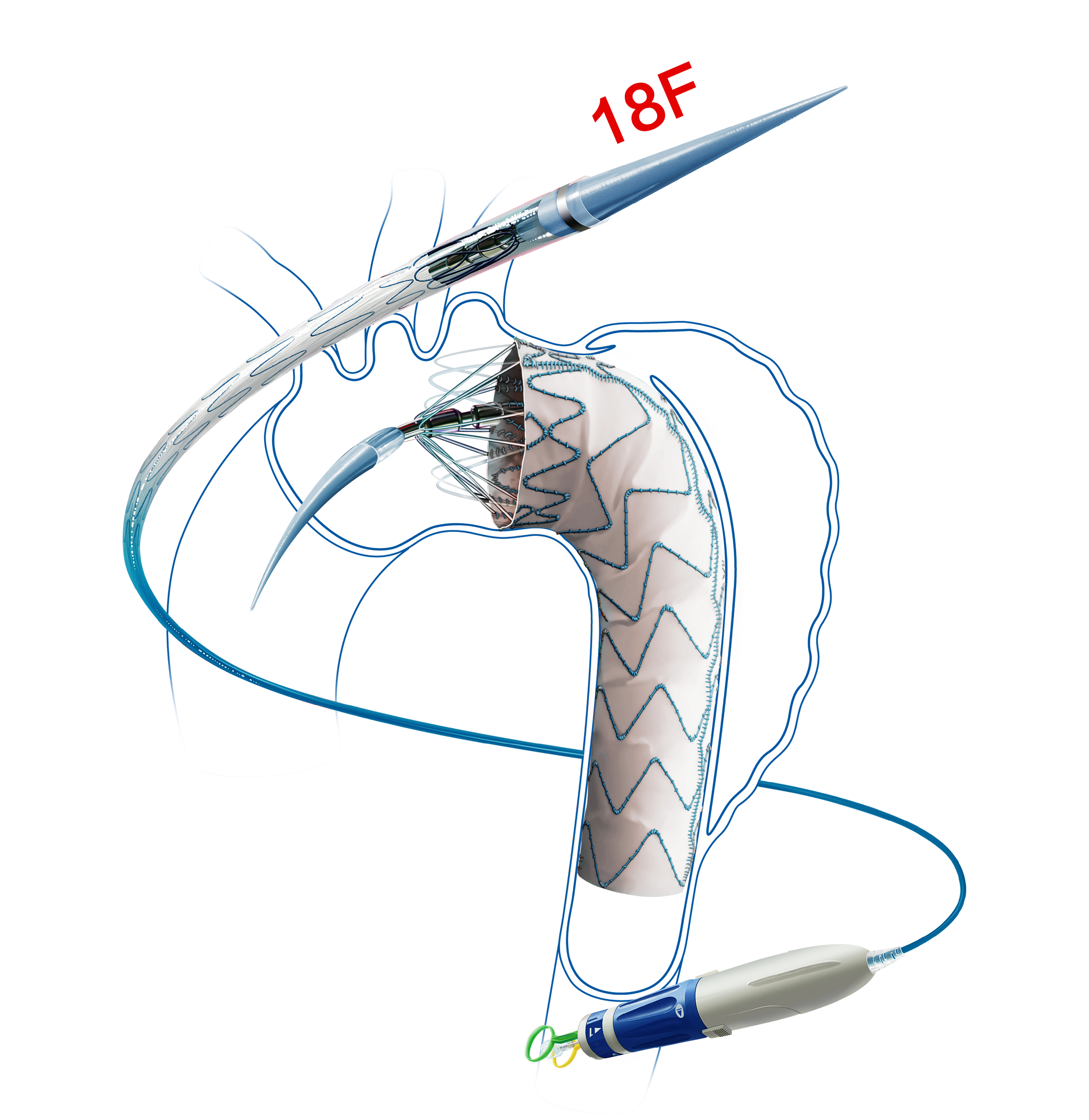 Hercules? Thoracic Stent Graft System with Low Profile Delivery System